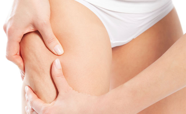 463187-Como-evitar-celulites-1