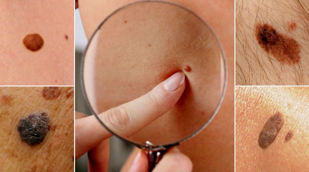 pinta-mancha-cancer-de-pele